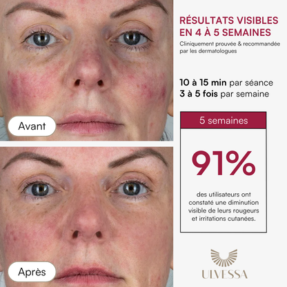 Máscara LED facial profesional - ULVESSA Serie 2